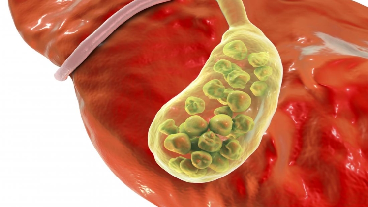 How to Stop a Gallbladder Attack While it is Happening