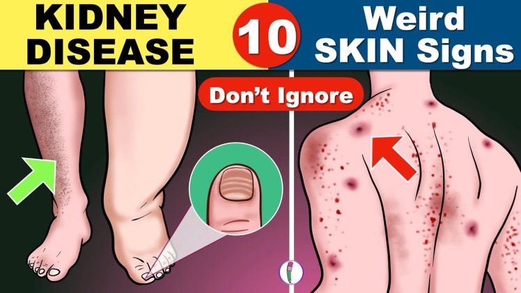 What Are the 3 Early Warning Signs of Kidney Disease