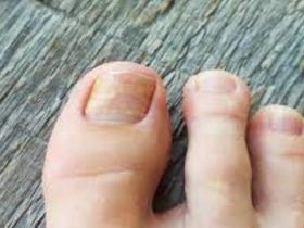 What is the Most Effective Treatment for Toenail Fungus